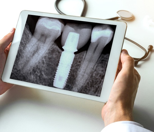 dentist looking at patient X-rays on a tablet   