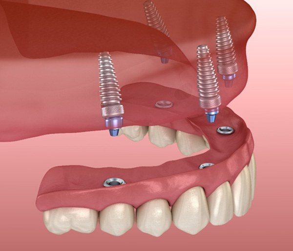 implant denture on upper arch  