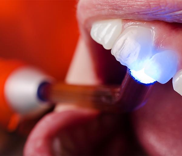 Patient receiving cosmetic dental bonding treatment