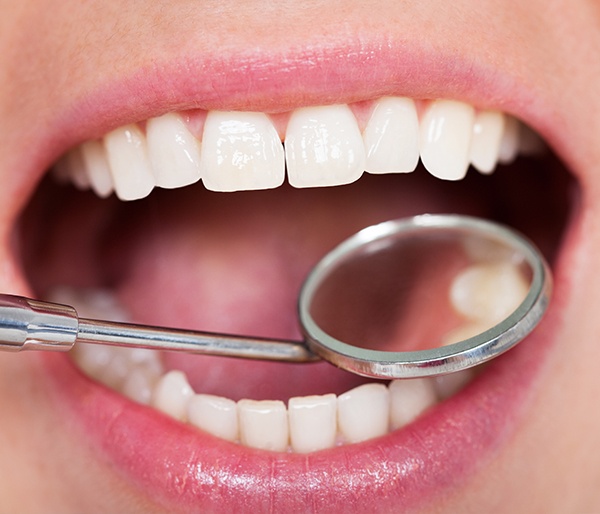 Closeup of smile after tooth colored filling placement