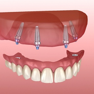 Digital model of an implant denture