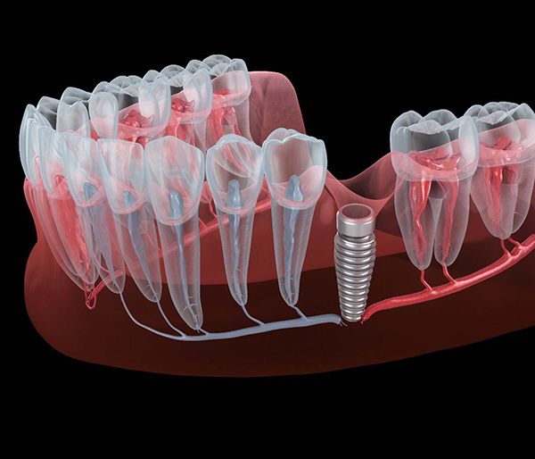 Failed dental implant in Flint