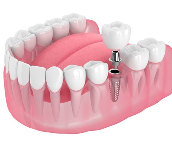 single dental implant with crown 