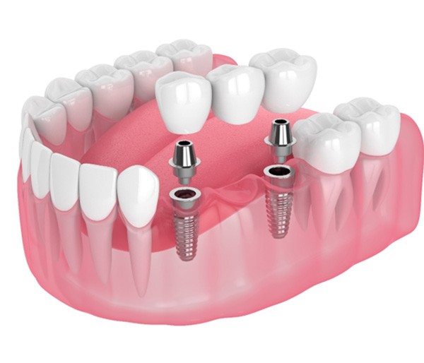 Dental implant specialist showing patient a dental implant model