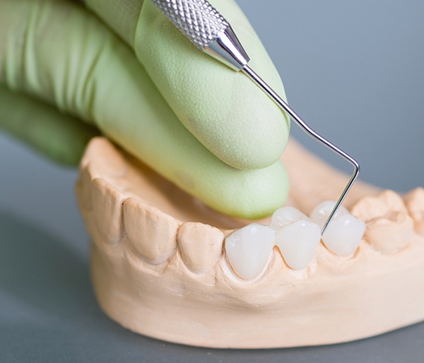 Model smile with dental bridge restoration