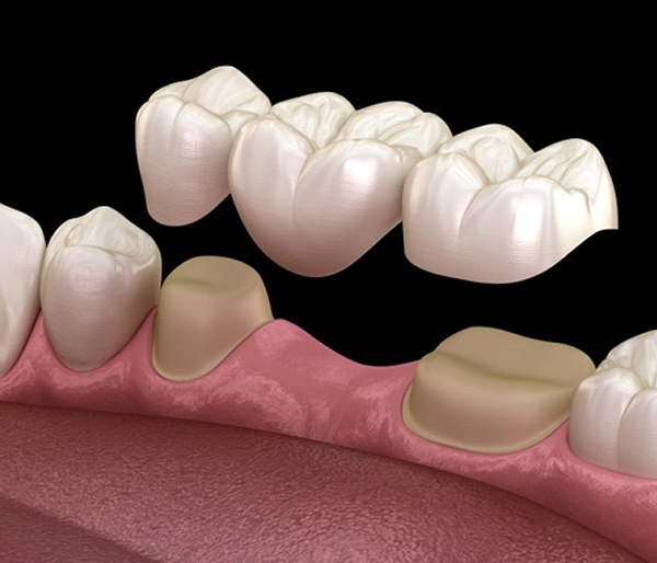 A diagram of a dental bridge.