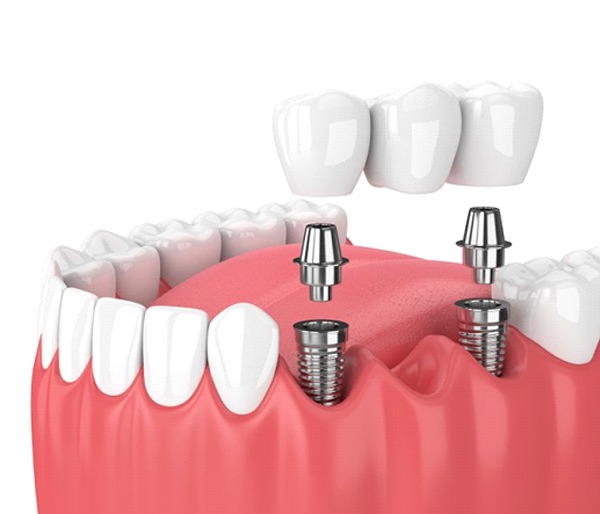 A diagram of an implant-retained bridge.