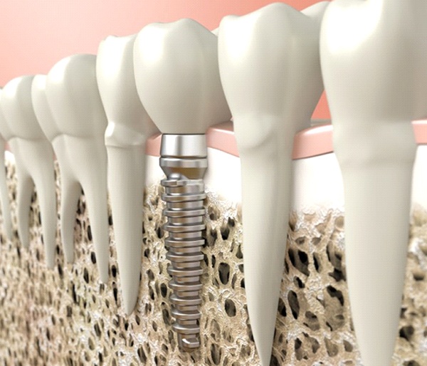 Animated dental implant supported dental crown