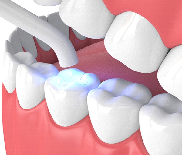 A digital image of a curing light being used to harden the composite resin in a tooth in Flint