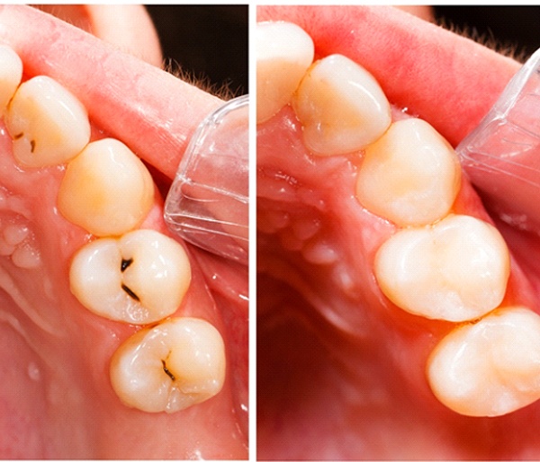 A before and after image of an individual who received three tooth-colored fillings in Flint