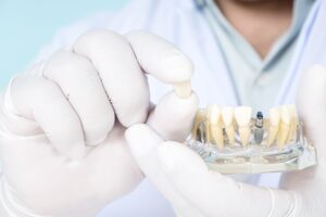 Gloved hands holding dental crown and model teeth with dental implant