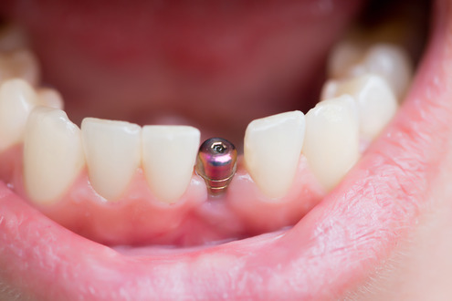 person smiling with dental implant in mouth 