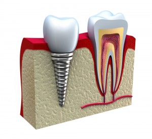 Shutterstock Dental Implant
