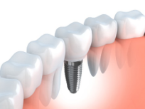 Dr. Naik is your dentist for dental implants in Flint.