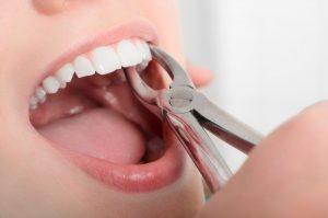 woman having a tooth extracted